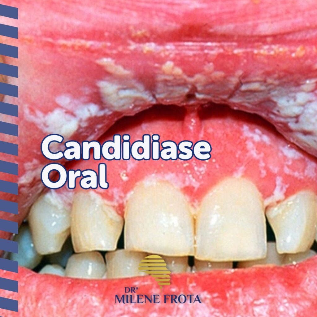 5 Problemas na língua e suas causas - Dra. Milene Frota